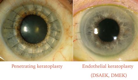 thick cornea measurement a 6|full thickness cornea transplant.